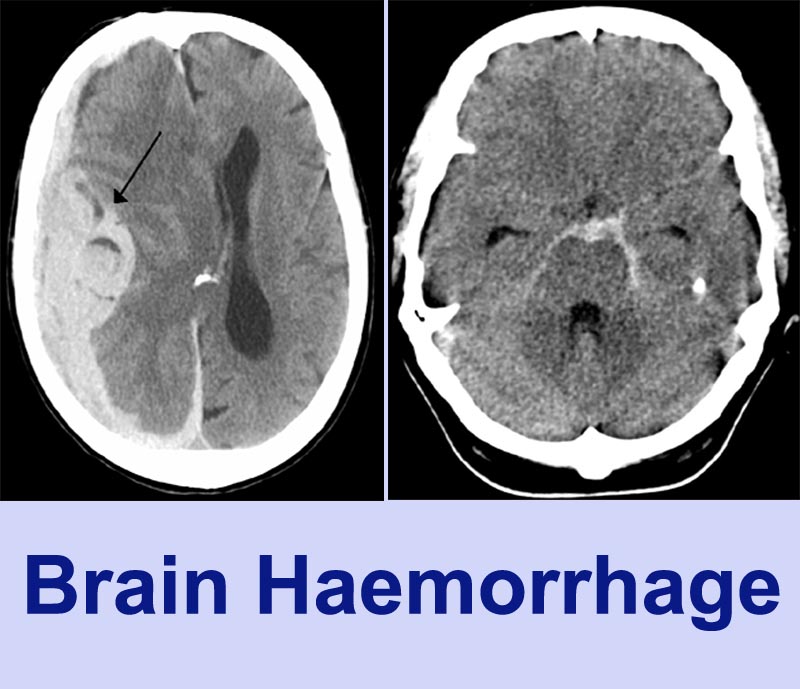 Brain Hemorrhage Treatment by Dr Tarun Kumar Adukia at Neuro Clinic Ranchi