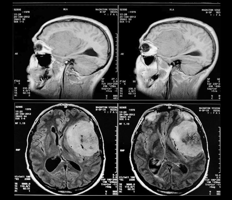 Brain Tumor Treatment by Dr Tarun Kumar Adukia at Neuro Clinic Ranchi