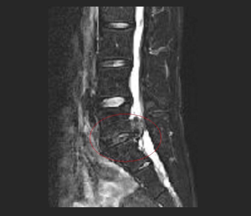 Spinal Tumor Treatment by Dr Tarun Kumar Adukia at Neuro Clinic Ranchi